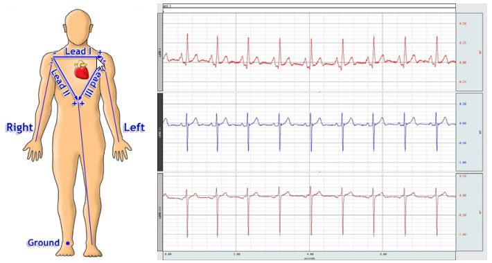 6 Lead EKG