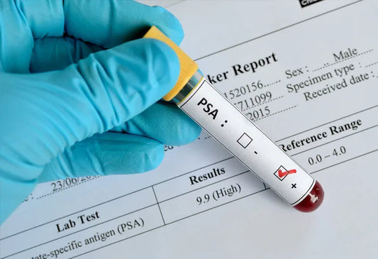 PROSTATE (PSA) TEST